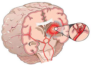 7,8-дигидроксифлавон: инсульт и травма головного мозга