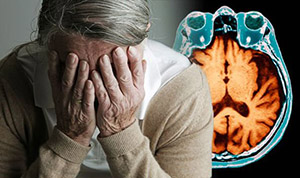  Болезнь Альцгеймера: диагноз