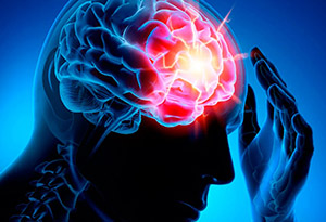  Гинкго (Гинкго Билоба) при инсульте