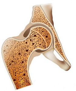 Горянка (Эпимедиум): остеопороз