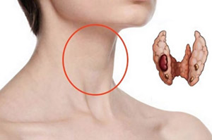 Йод: зоб или разрастание щитовидной железы