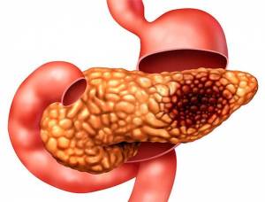 лечение рака поджелудочной железы