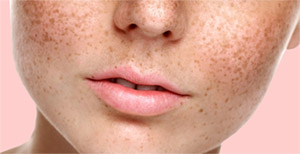 Меланотан 2: эффекты пигментации