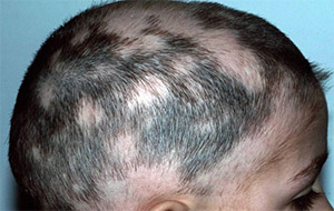 Алопеция является аутоиммунным расстройством, которое может привести к потере волос, начинающейся с одного участка (Alopecia areata monolocularis)