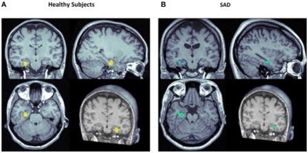 Значительно усиленное (желтый) и ослабленное rCBF (кровоснабжение головного мозга) в левой области гиппокампа у здоровых испытуемых(A) и у лиц с социальным тревожным расстройством(SAD; B) после применения КБД vs. плацебо.