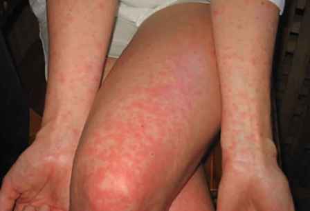 Характерная сыпь - один из симптомов лихорадки денге.
