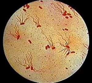 Брюшной тиф, также известный просто как тиф – бактериальная инфекция, вызванная сальмонеллой тифи.