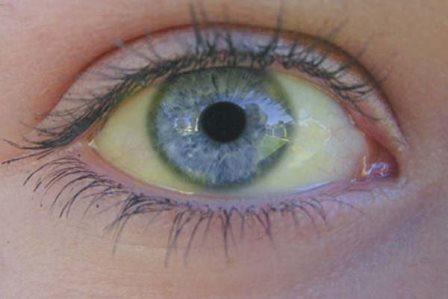Пожелтение глаз - один из признаков гепатита.